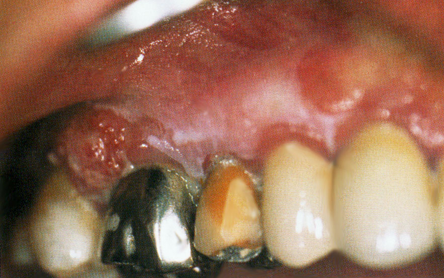 Carcinome épidermoïde gingival