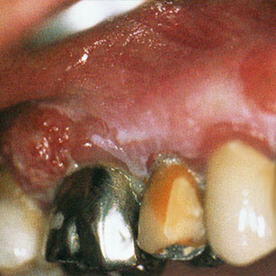 Carcinome épidermoïde gingival