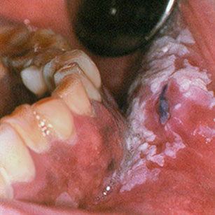 Leucoplasie inhomogène rétrocommissurale