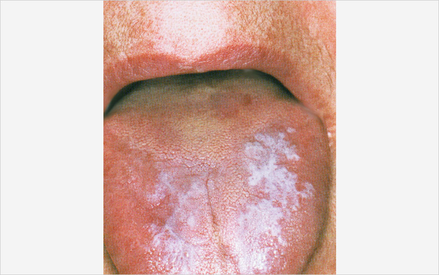 Lichen plan buccal Forme hyperkératosique en plaque de la langue