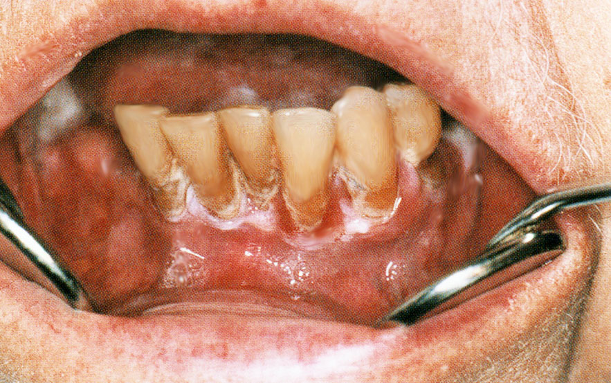 Forme hyperkératosique et verruqueuse gingival