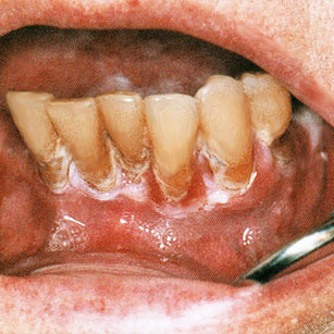 Forme hyperkératosique et verruqueuse gingivale