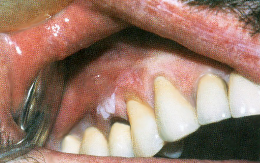 Leucoplasie homogène gingivale