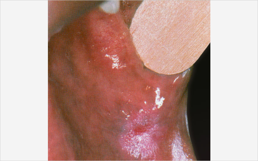 Leucoplasie inhomogène rétrocommissurale