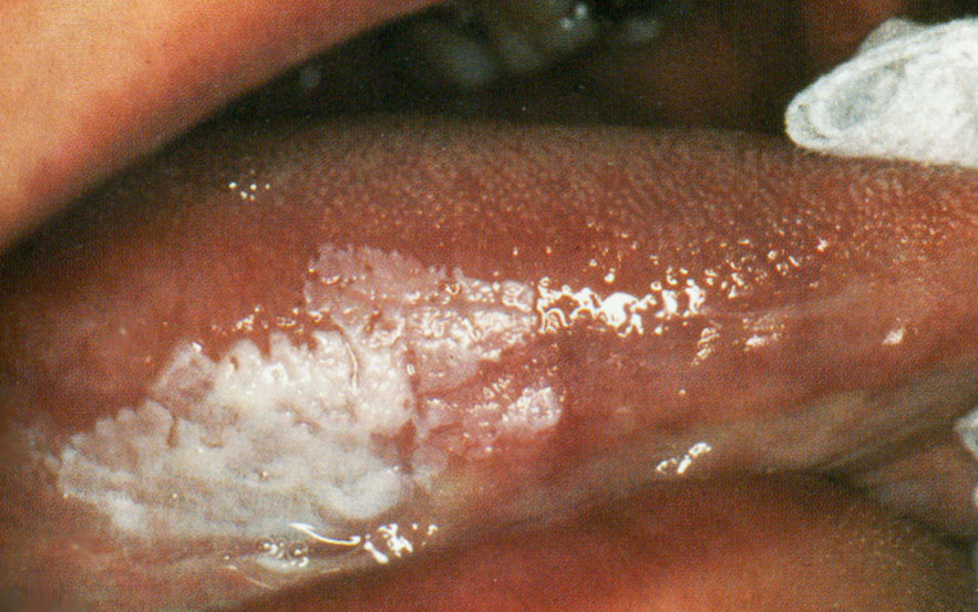 Leucoplasie verruqueuse