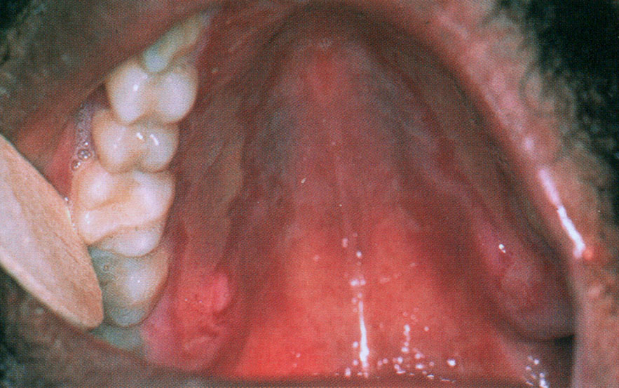 Brûlure caustique par bain de bouche. Dr Lotfi Benslama, Paris 16