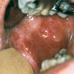 Perlèche candidosique , commissures labiales, candidose, édenté, effondrement dentaire