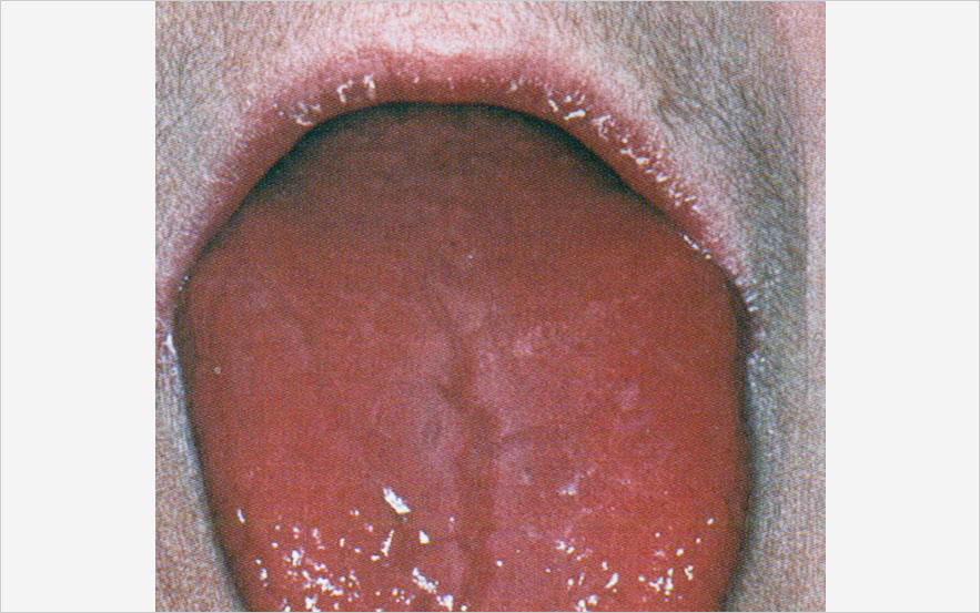 carence en vitamine B12, glossite de Hunter, maladie de Biermer, myélogramme, mégaloblastose médullaire, fibroscopie gastrique, biopsie Carence en vitamine B12
