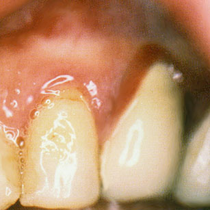 Lichen plan gingival