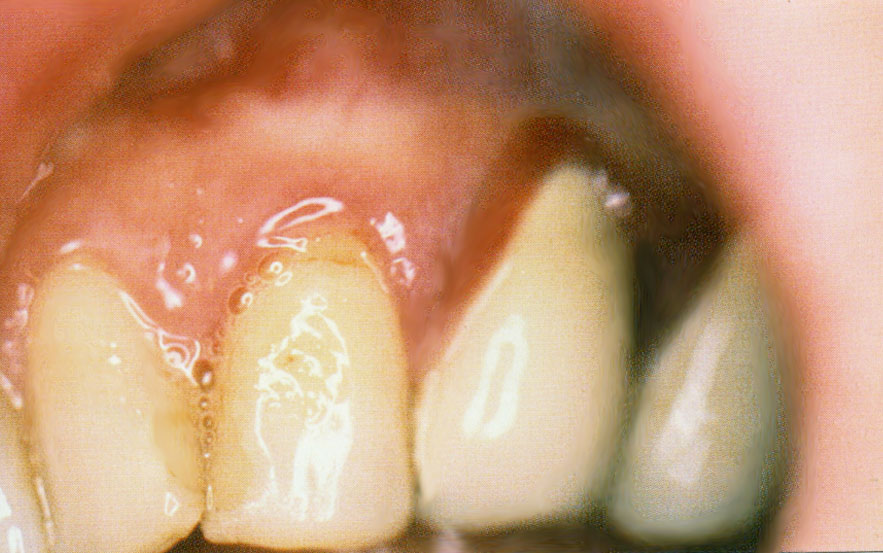 Lichen plan gingival