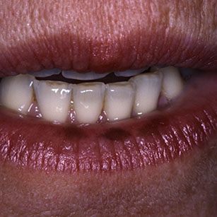 Pigmentation des lèvres et de la muqueuse buccale