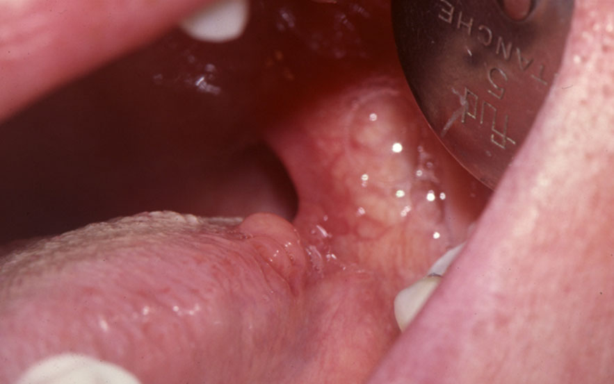 Papilles hypertrophique, infection des voies aéro-digestives supérieures ou irritation Amygdales linguales