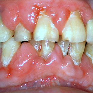 Hypertrophies gingivales Adalate®