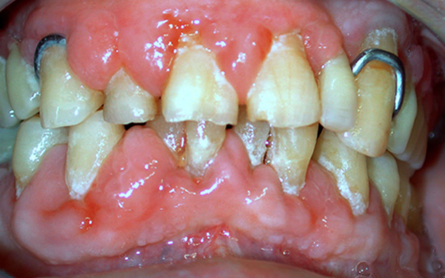 Hypertrophies gingivales Adalate®