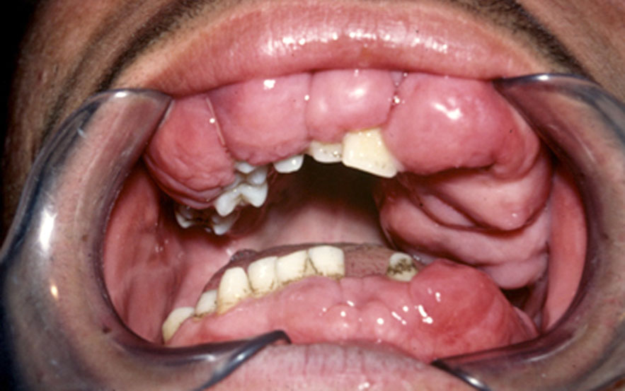 Hypertrophies gingivales idiopathiques