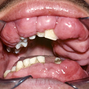 Hypertrophies gingivales idiopathiques