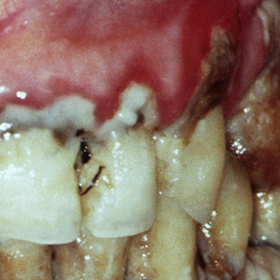 Gingivite ulcéro-nécrotique