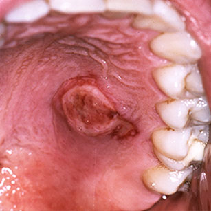 Ulcérations d'origine infectieuse bactérienne