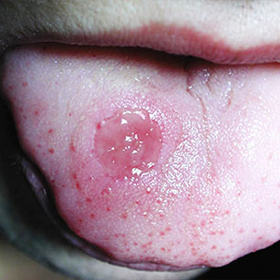 Syphilis primaire