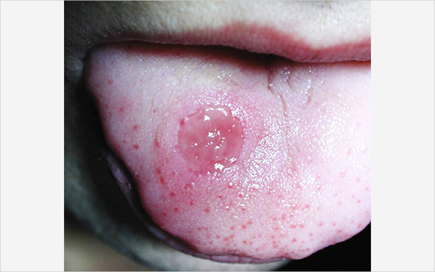Chancre syphilitique d'inoculation, localisations génitale ou anale Syphilis primaire