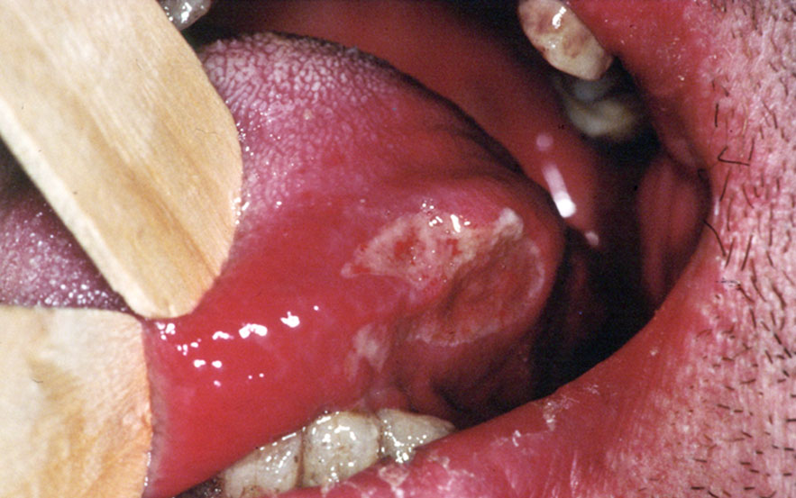 Ulcération buccale tuberculeuse, langue, lésions pulmonaires Tuberculose