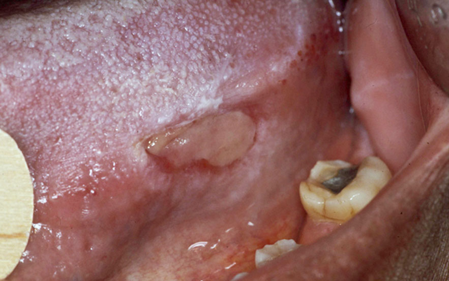 ulcération traumatique, diagnostic Ulcération traumatique d'origine dentaire